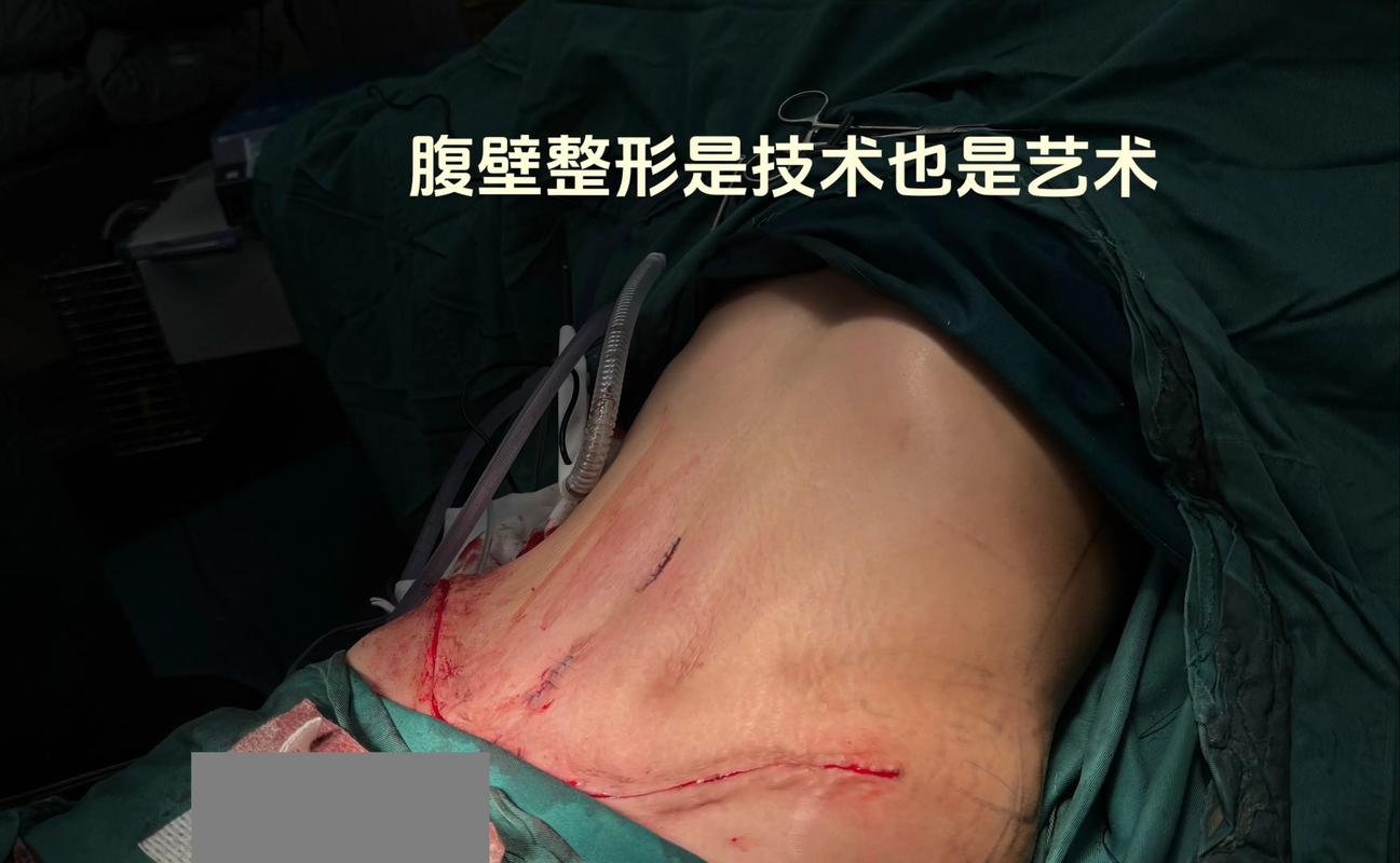 如何同过整形手术实现腹部塑形效果？