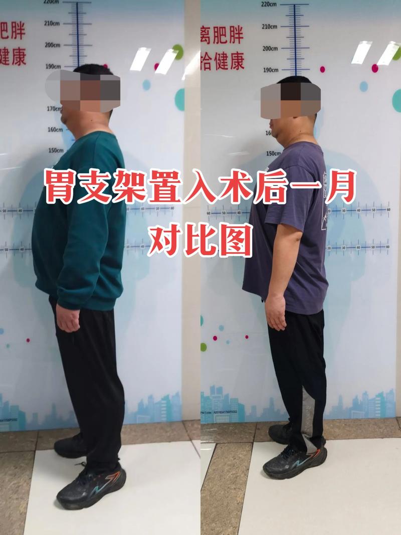 胃肠减肥手术适合体型较胖的资深人士吗？