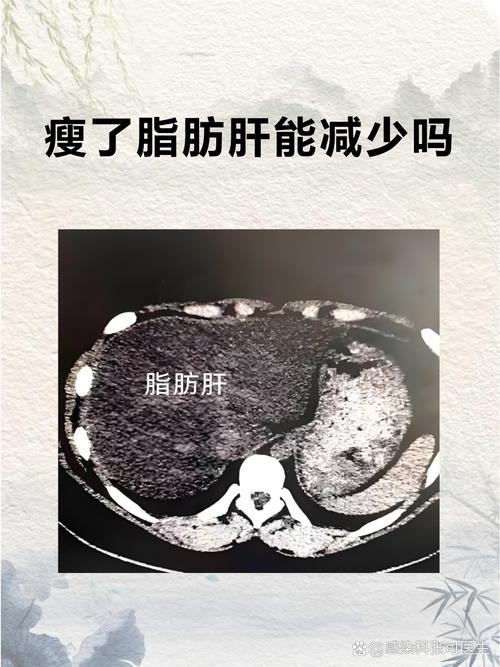 长期减肥却饿出脂肪肝，这是真的吗？