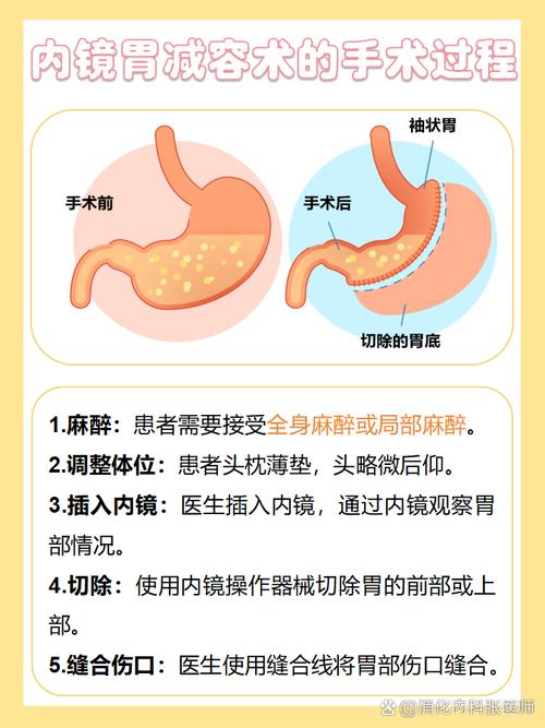 可调节胃束带手术真的能帮我快速减肥吗？