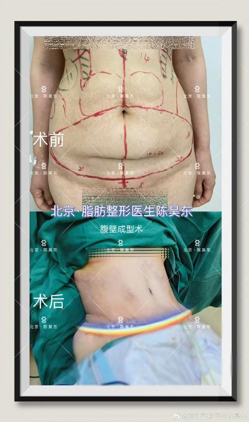 腹部吸脂减肥术是哪种整形手术？