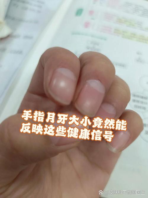 手指月牙能准确判定我的肥胖吗？