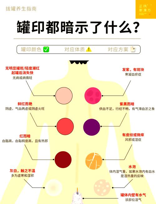 拔罐减肥，罐斑能反映出哪些健康问题吗？