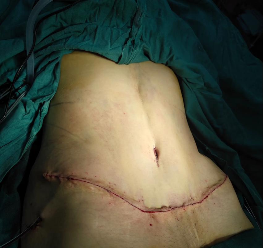 如何同过整形手术实现腹部塑形效果？