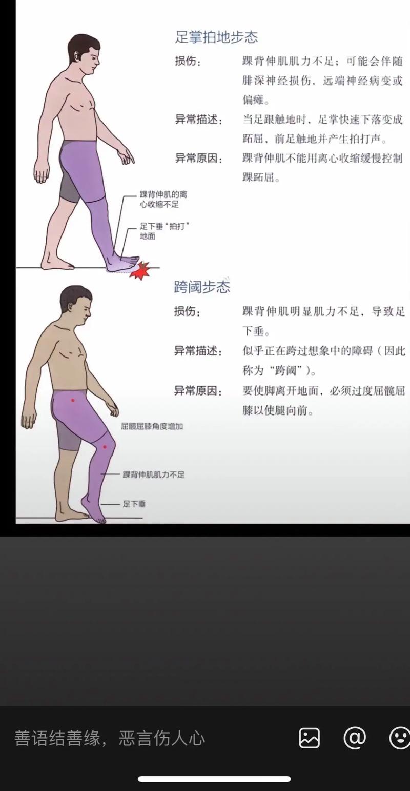 走路姿势不当会导致腿型不美观，有哪些常见的不良走路姿势需要注意呢？