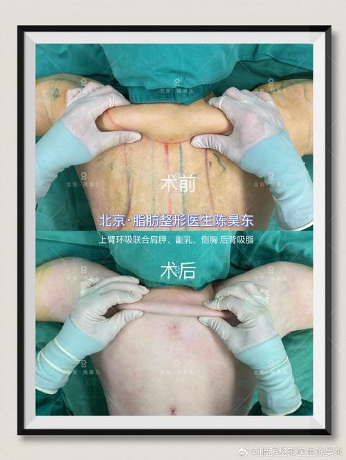 背部抽脂减肥术安全吗？效果如何？适合我吗？