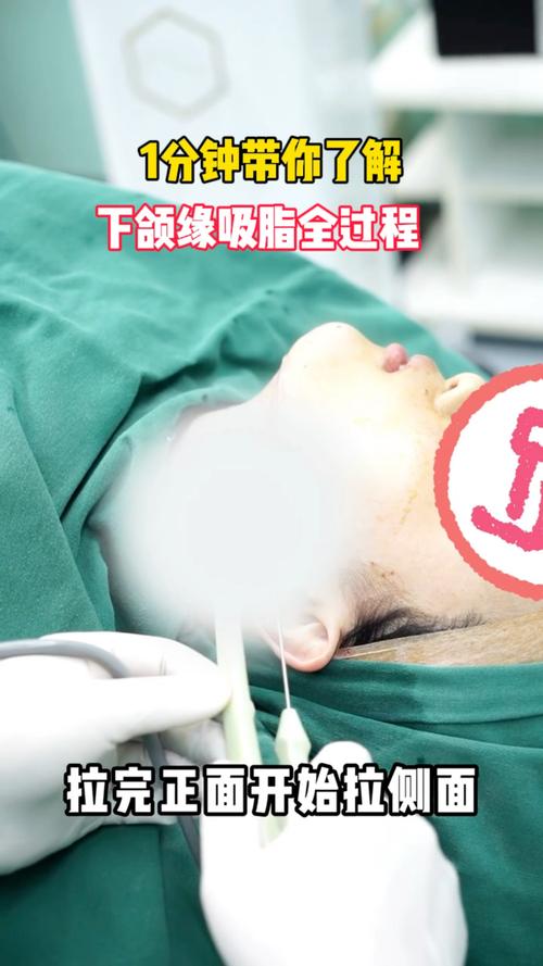 吸脂手术是如何实现脸部脂肪减少，进而达到瘦脸目的的？
