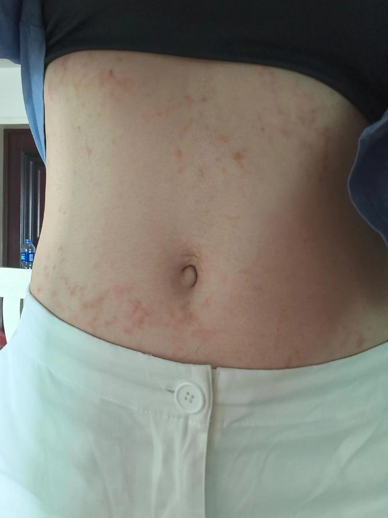 乱服减肥药后会出现哪些恐怖症状？