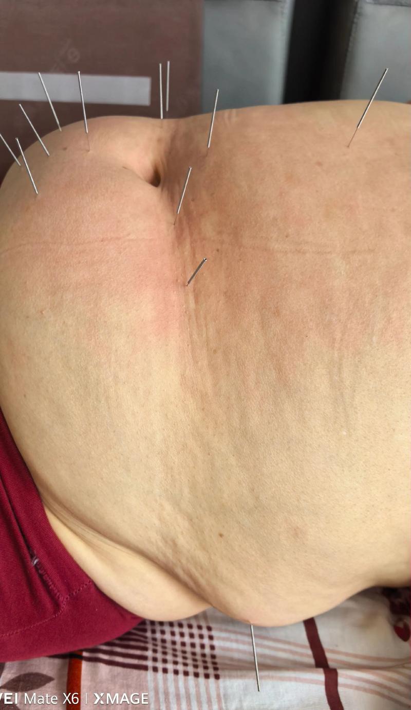 针灸能成功治疗肥胖症，实现减肥效果吗？