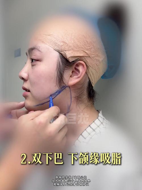 颈部抽脂术能彻底去除双下巴，让无痕效果立竿见影吗？