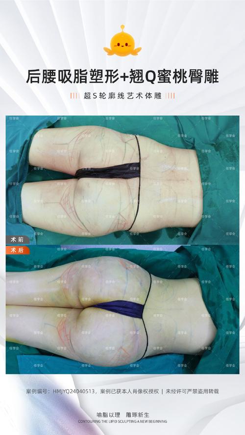 自体脂肪丰臀术适合哪些人群进行？