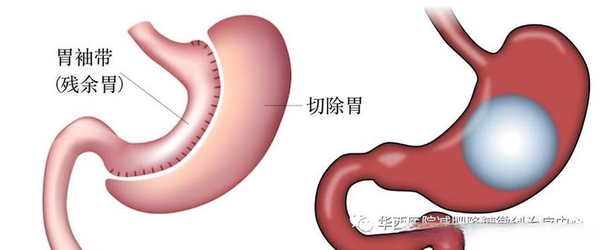 腹腔镜束带式胃减肥手术的原理是什么？