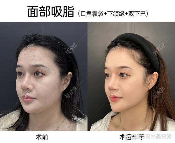 微创面部吸脂术能瘦脸不留痕吗？
