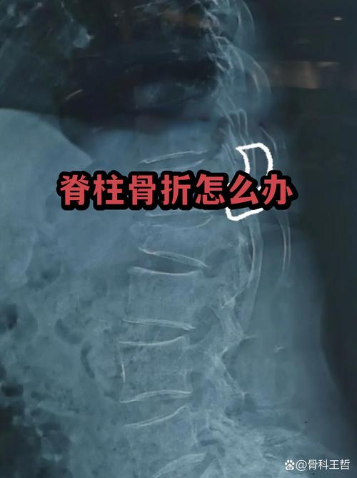 白领追求骨感美，骨骼受伤怎么办？