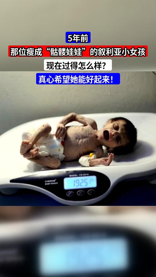 女孩减肥过度，变成骷髅般可怕，这是真的吗？