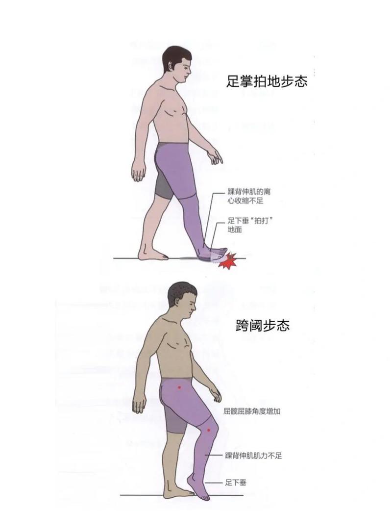 走路姿势不正确会导致体重增加吗？