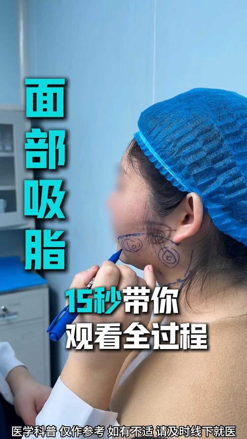 吸脂手术是如何实现脸部脂肪减少，进而达到瘦脸目的的？