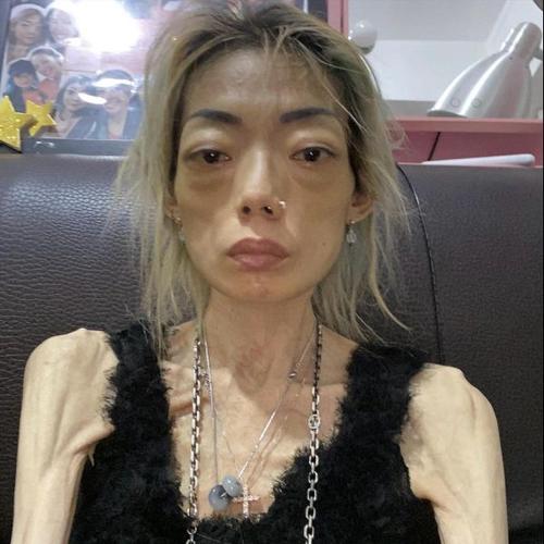 骨瘦如柴的人减肥后真的容易患上可怕的疾病吗？