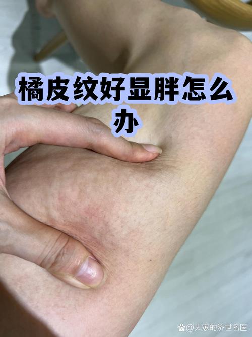 如何有效消除恼人肥胖橘皮纹困扰？