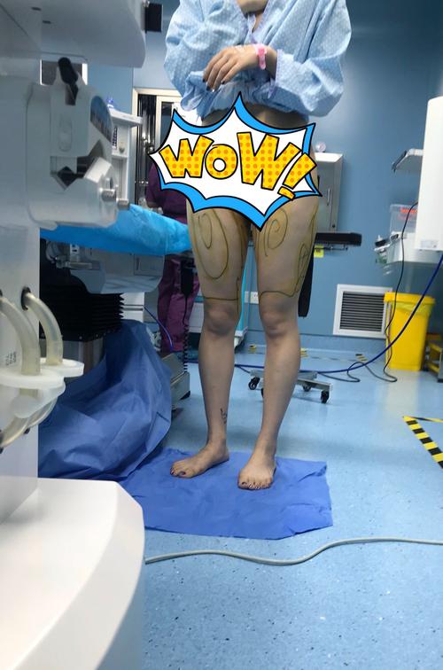 抽脂手术的真实体验是怎样的？术后效果和恢复过程如何？