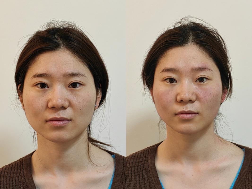 长期坚持瘦脸抗衰老，效果嫩媲美整容吗？