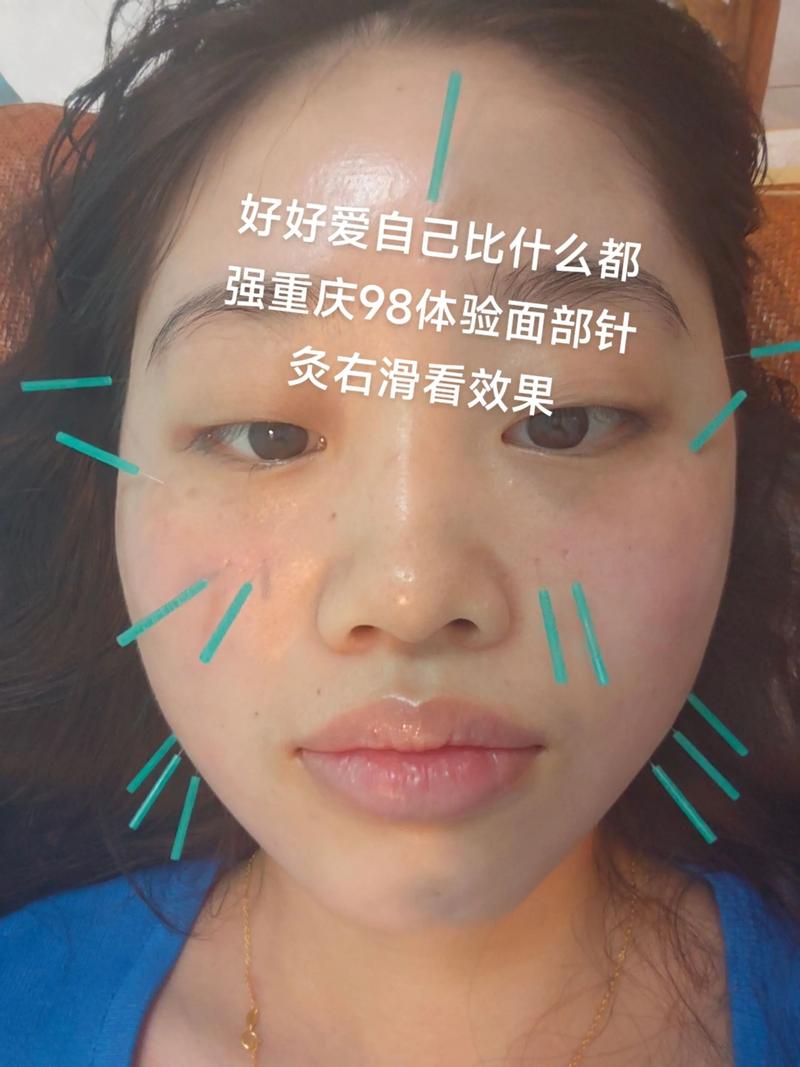 颜面针灸瘦脸效果如何？有没有推荐的专家？
