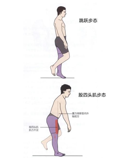 走路姿势不正确会导致体重增加吗？