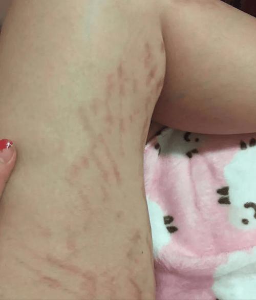 如何有效预防减肥过程中出现的肥胖纹？