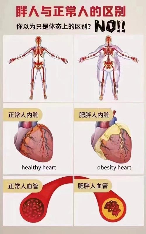 哪种肥胖类型更容易导致心血管疾病？