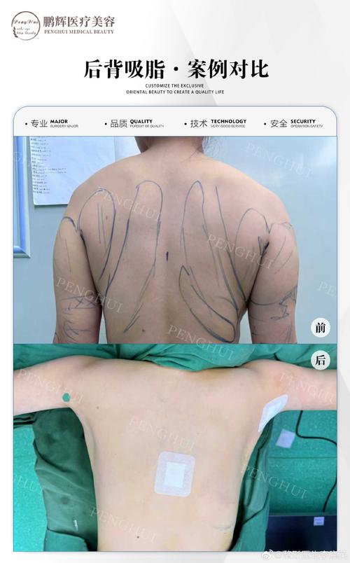 背部吸脂减肥有哪些显著优势？