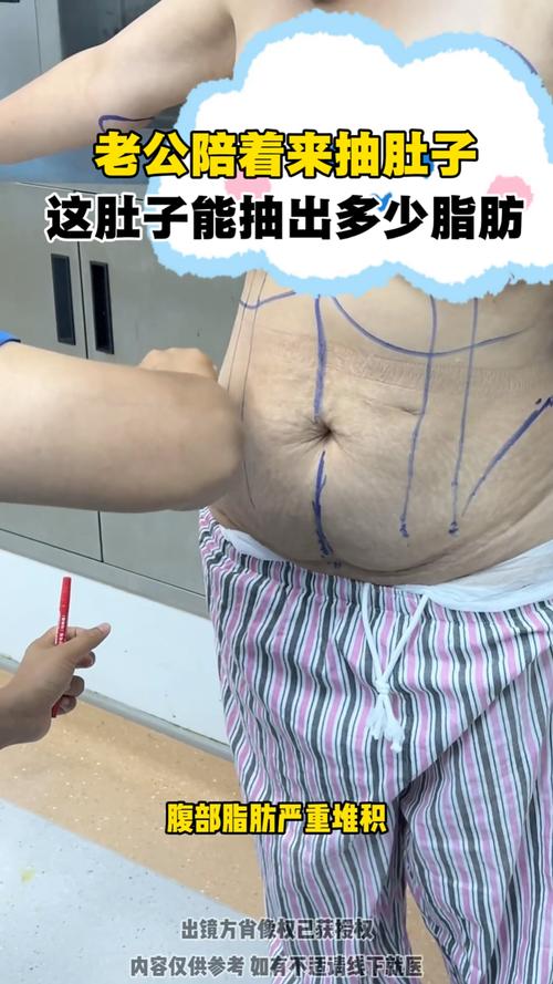 大腹便便的男人是不是最该考虑抽脂呢？