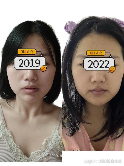 拔牙真的能瘦脸吗？小心小脸变瘪嘴有风险？