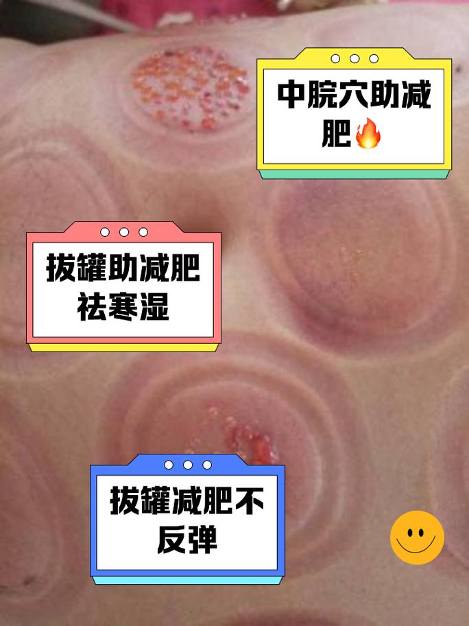 神奇中医拔罐减肥法，如何有效击退厚脂肪？