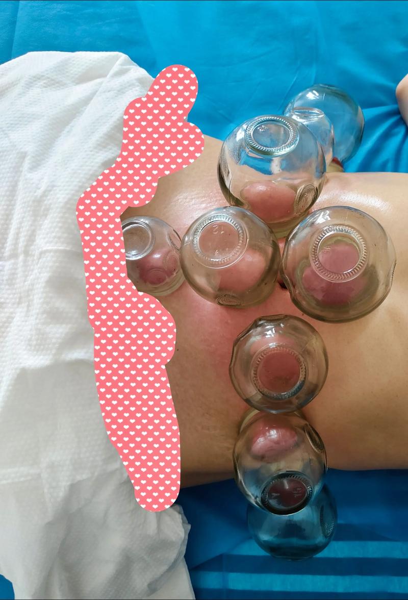 中医拔罐减肥疗法真的能让我有效抑制脂肪堆积吗？