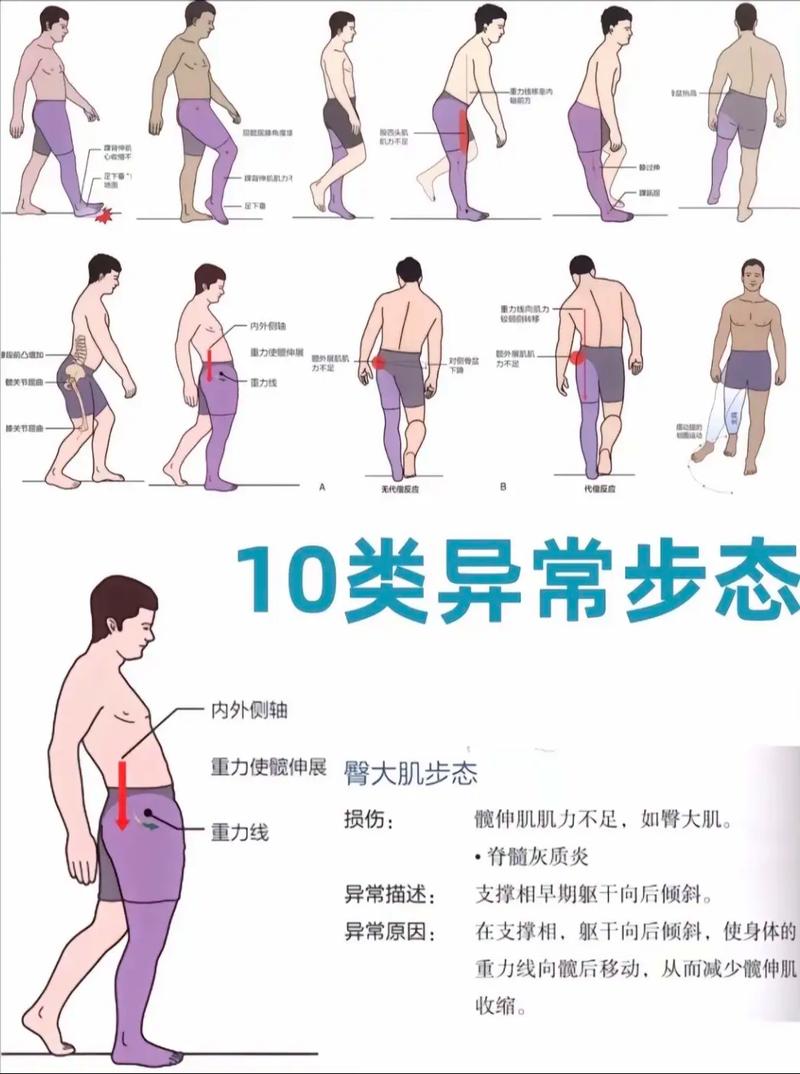 走路姿势不当会导致腿型不美观，有哪些常见的不良走路姿势需要注意呢？