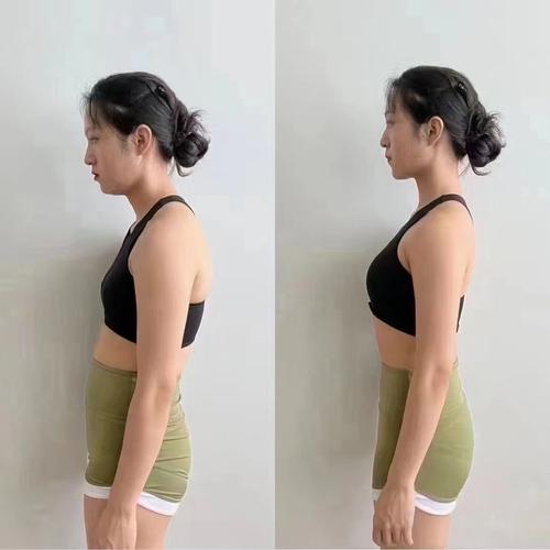 警惕！骨盆歪斜会导致长出小肚子吗？