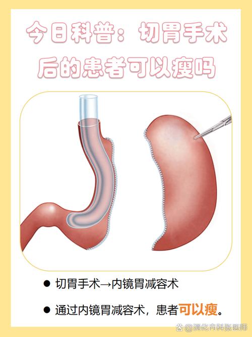 可调节胃束带手术真的能帮我快速减肥吗？