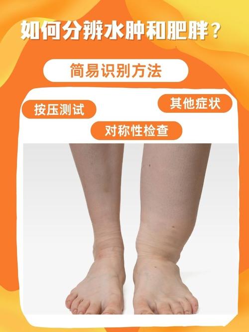 肥胖和水肿有什么区别？如何准确鉴别？