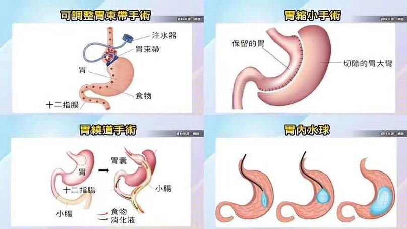 腹腔镜束带式胃减肥手术的原理是什么？