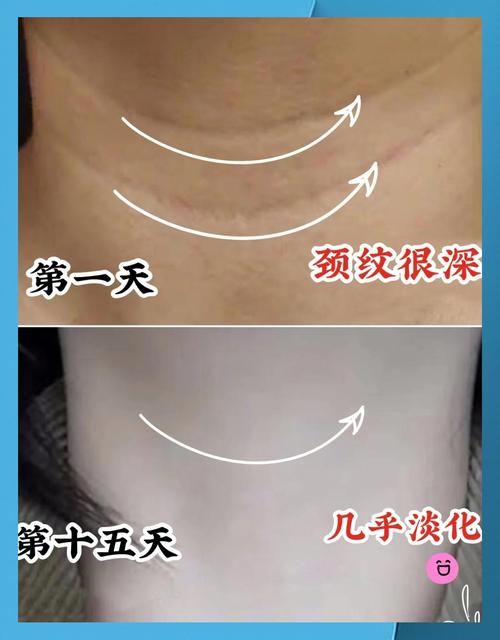 为什么驼背容易长颈纹？有哪些不良习惯会导致颈纹出现？