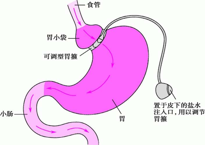 可调节胃束带手术真的能帮助减肥吗？