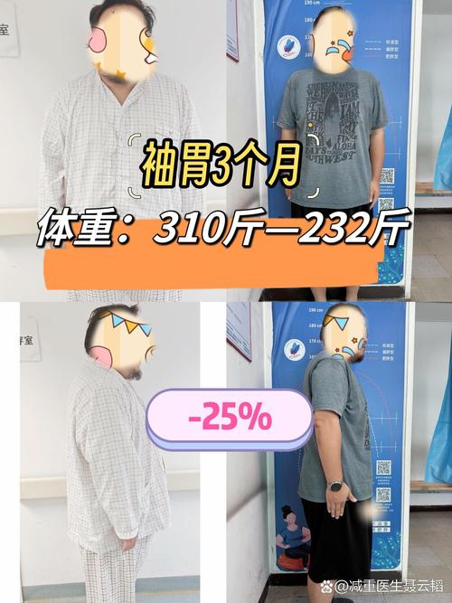 156公斤小伙接受缩胃手术减肥成功了吗？