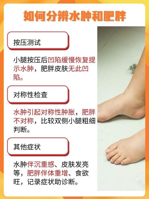 肥胖和水肿有什么区别？如何准确鉴别？